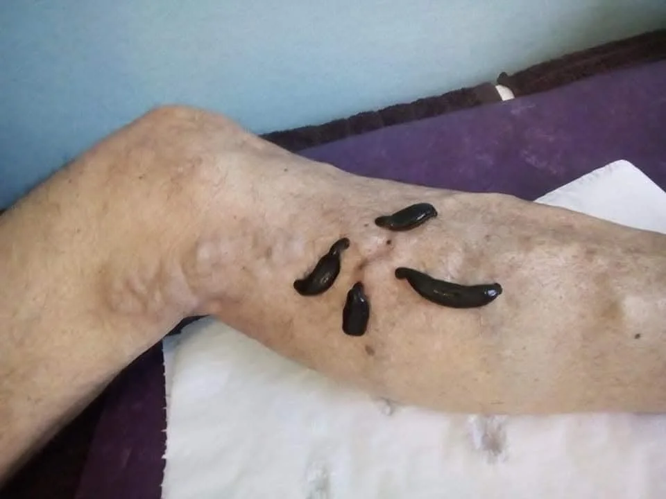 علاج بودة العلق الطبية